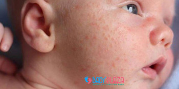 Cách trị rôm say cho bé theo phương thức dân gian cần lưu ý điều gì?