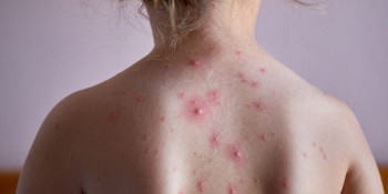 Bệnh thủy đậu là gì? Cách điều trị như thế nào ko để lại sẹo!
