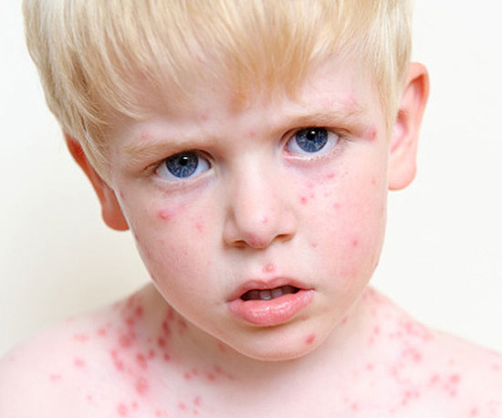 dấu hiệu bệnh thuỷ đậu ở trẻ nhỏ